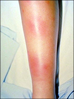 Neurology Leg Lesions