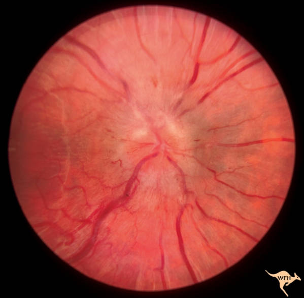 Neurology Retina