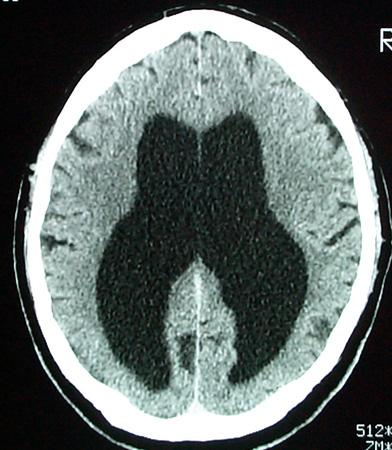 Neurology CT Brain