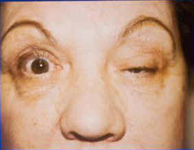 Neurology Face