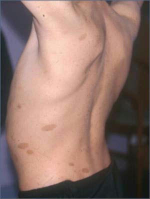Neurology Skin Lesions
