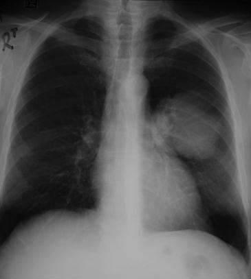 Medical Finals Quiz CXR 1
