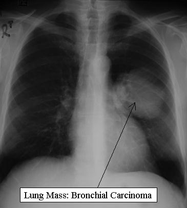 Medical Finals Quiz CXR 1 annotated