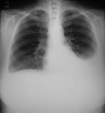 Chest X-Ray