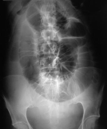 Abdominal X-Ray