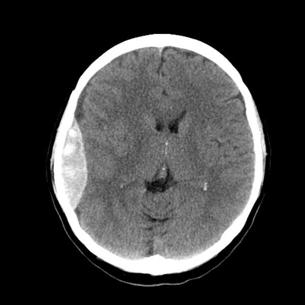 CT-brain 1