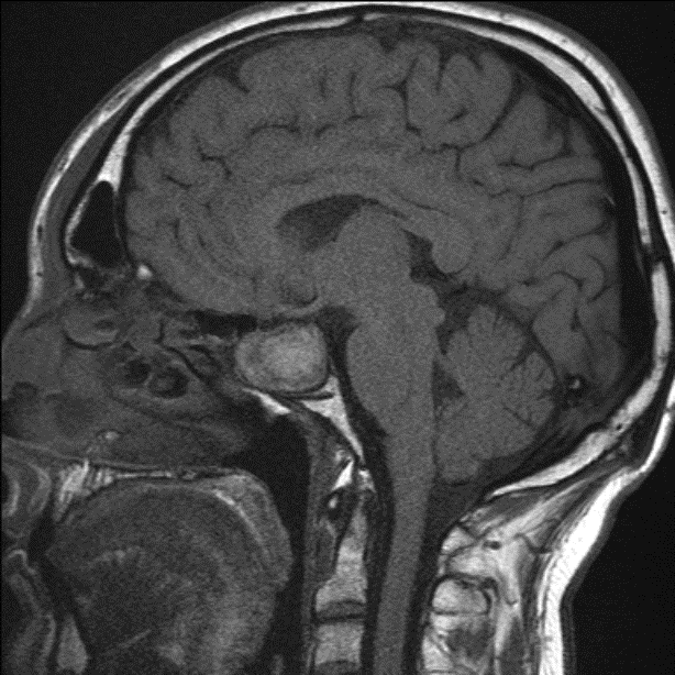 MRI-Brain 1