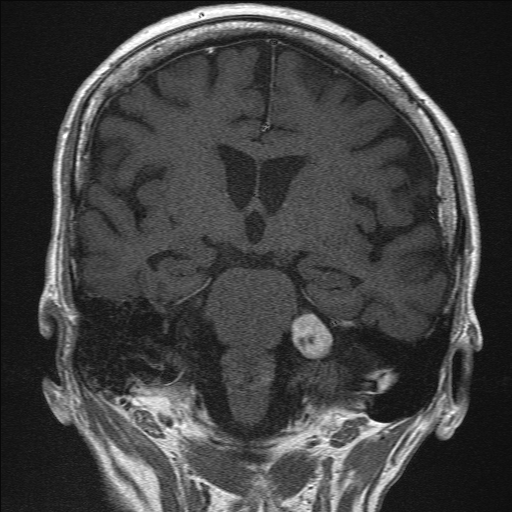 MRI-Brain 3