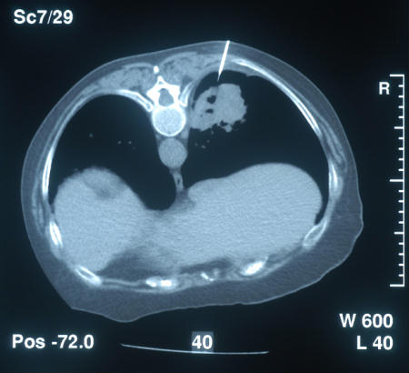 CT guided biopsy
