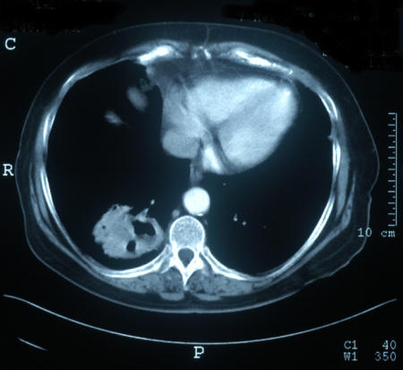 CT chest