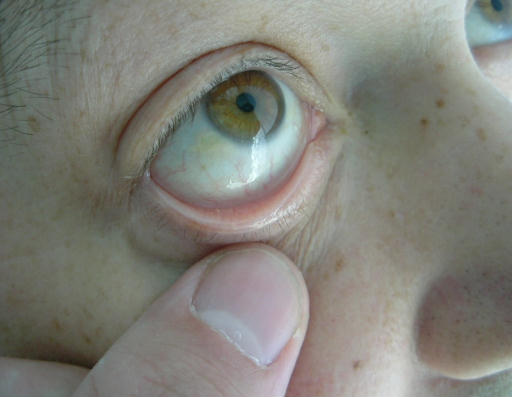 Anaemic Eye
