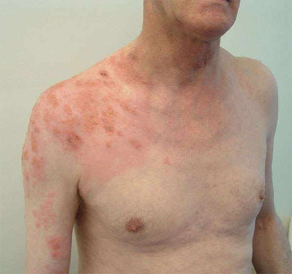 Right shoulder rash