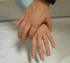 February Quiz MCP Squeeze test