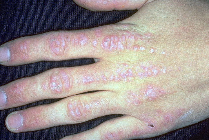 non-pruritic bluish/red nodules over the knuckles