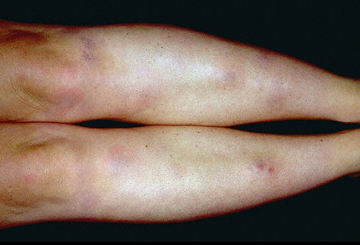 red, painful rash on the shins