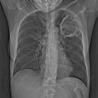 Chest X-ray