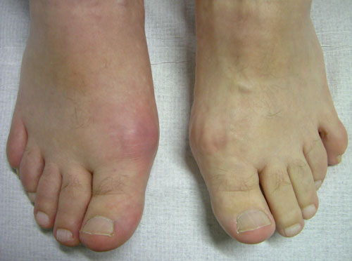 Gout