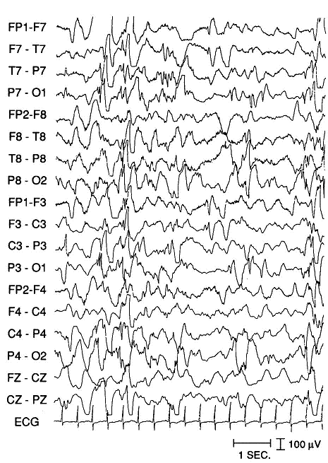 EEG