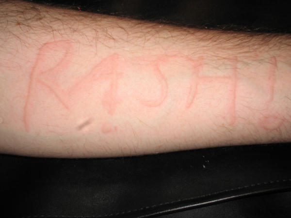 March Quiz Rash on arm