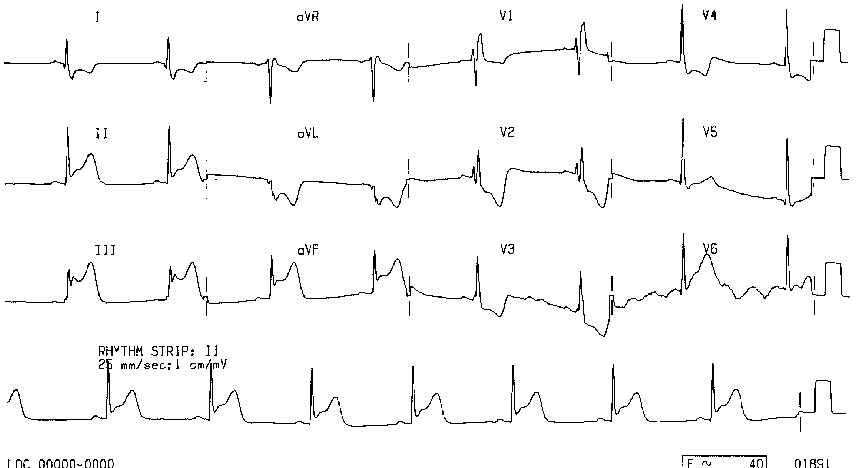 ECG 1