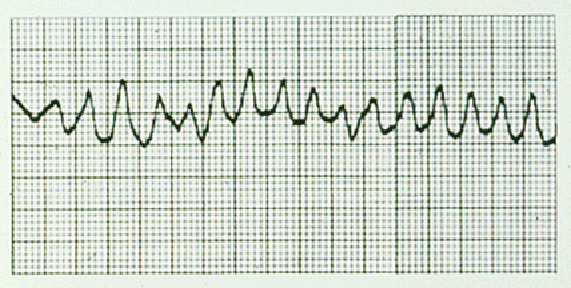 ECG 2