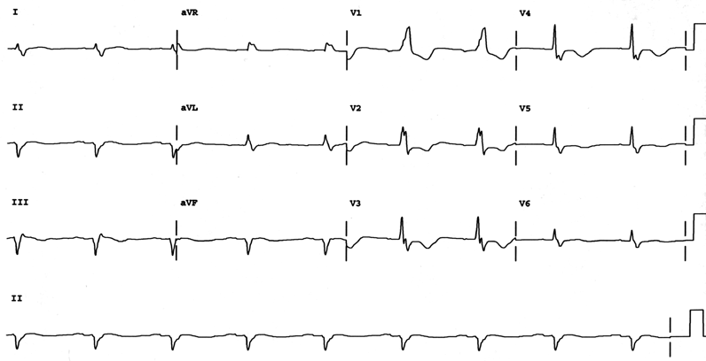 ECG 3