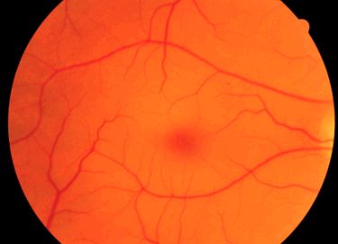 Retina