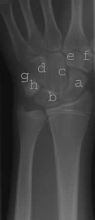 Wrist x-ray