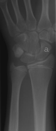 Wrist x-ray