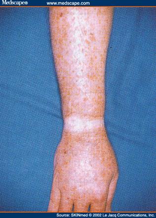 Skin pigmentation on arm