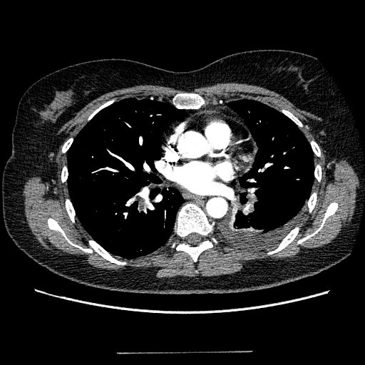 CT pulmonary angiogram
