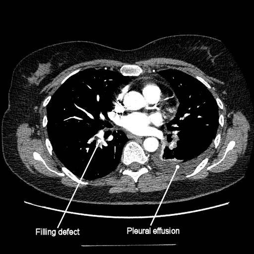 CT pulmonary angiogram annotated