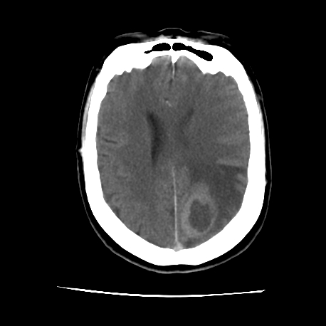 CT Brain