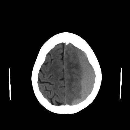 CT Brain